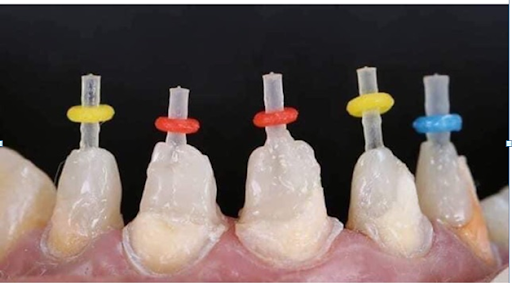 Khắc Phục Răng Thiếu Hụt Một Cách Hiệu Quả!