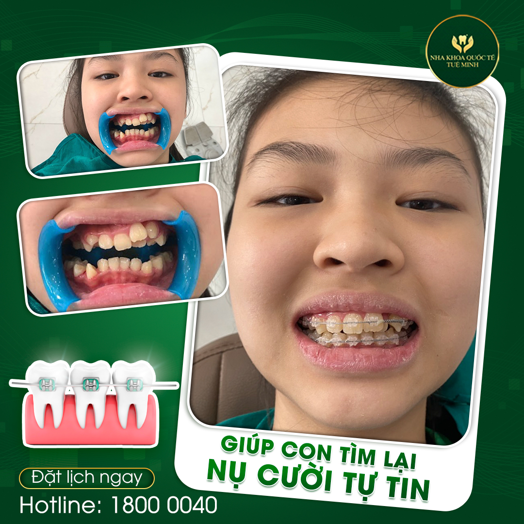 Niềng răng mắc cài sứ/phalê tại Nha Khoa Quốc Tế Tuệ Minh