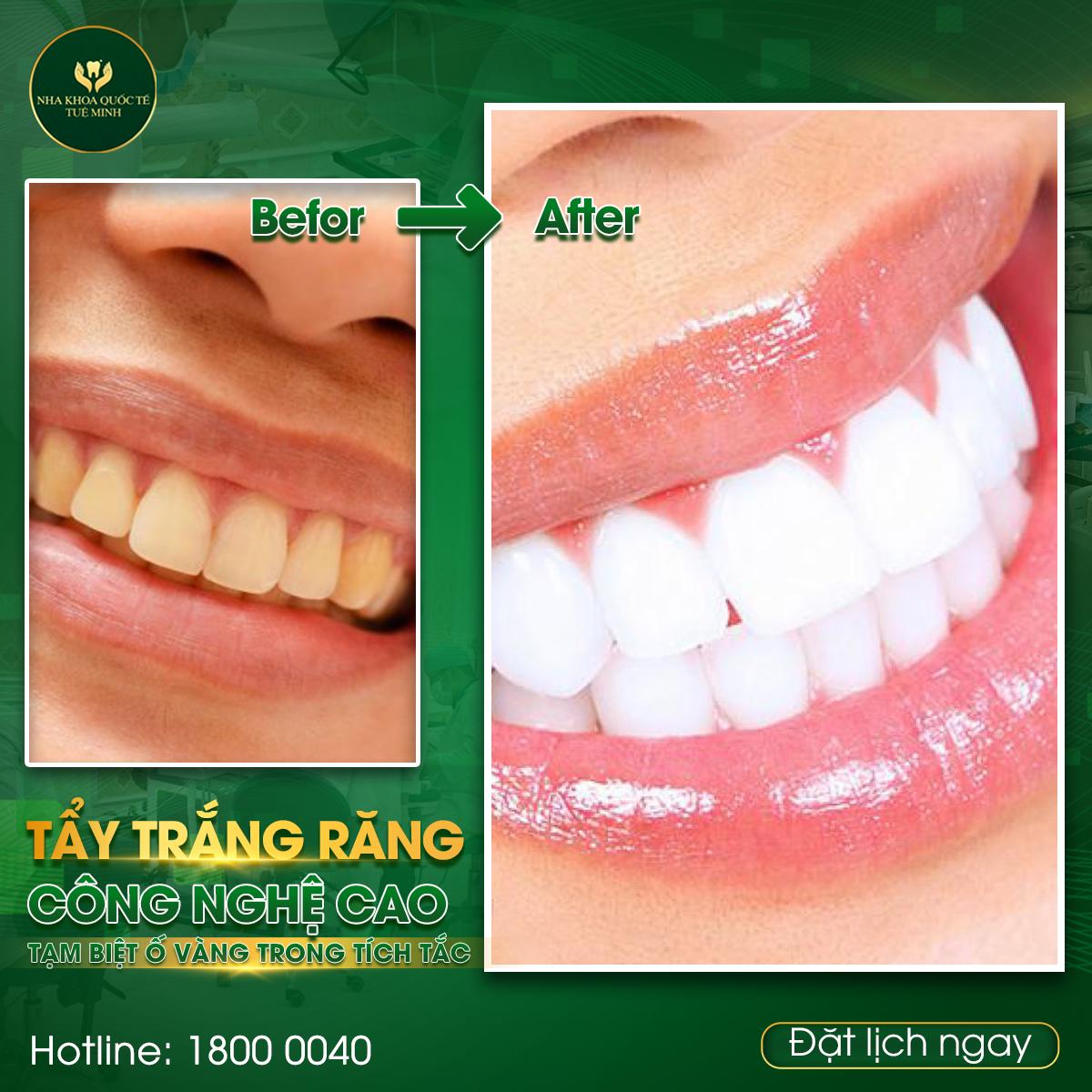 TẨY TRẮNG RĂNG CÔNG NGHỆ CAO – TẠM BIỆT Ố VÀNG TRONG TÍCH TẮC