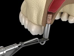 NHỮNG PHÁT SINH GÂY TỐN KÉM NẾU BẠN TRÌ HOÃN TRỒNG RĂNG IMPLANT