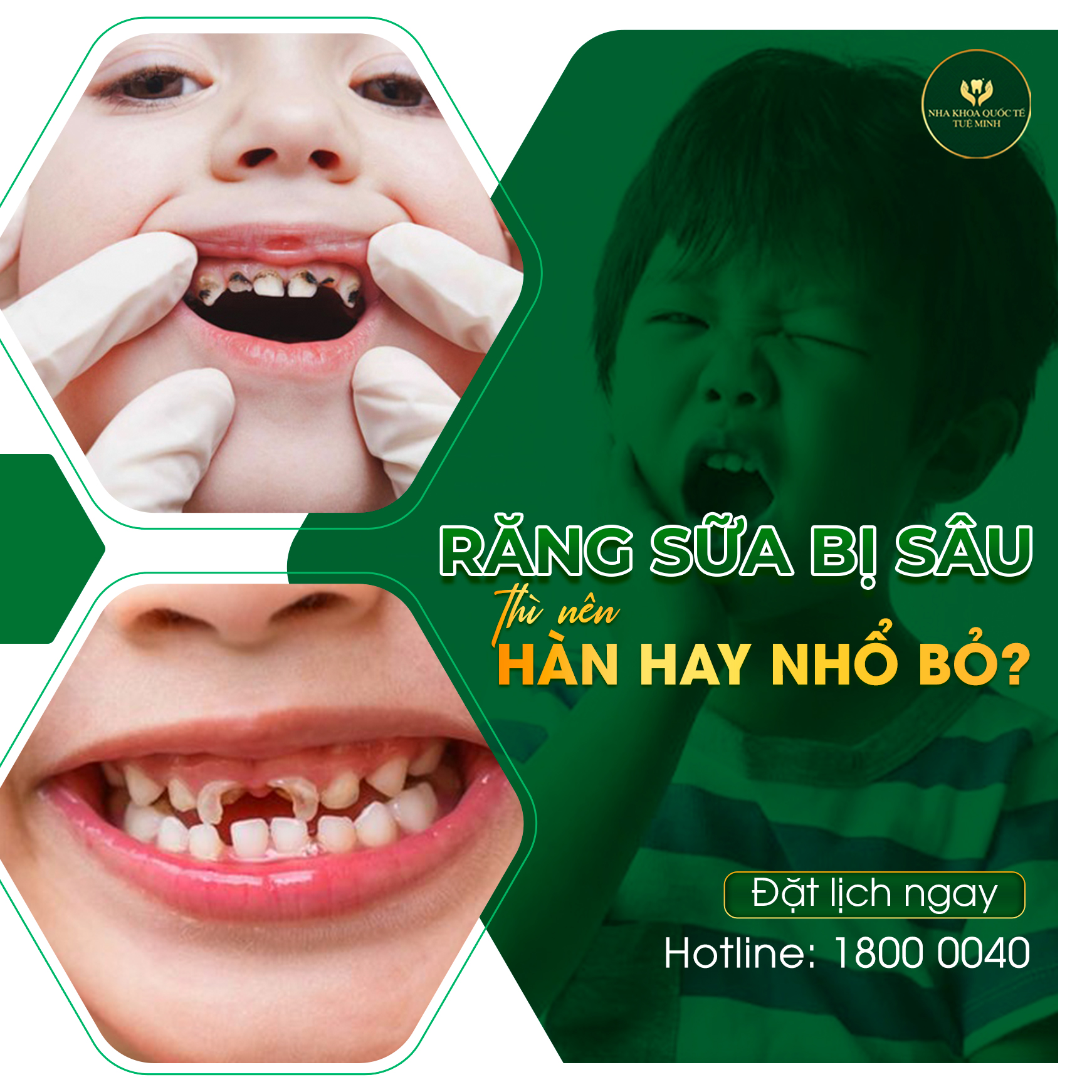 Sâu răng ở trẻ em: Nguyên nhân và dấu hiệu nhận biết lúc mới chớm