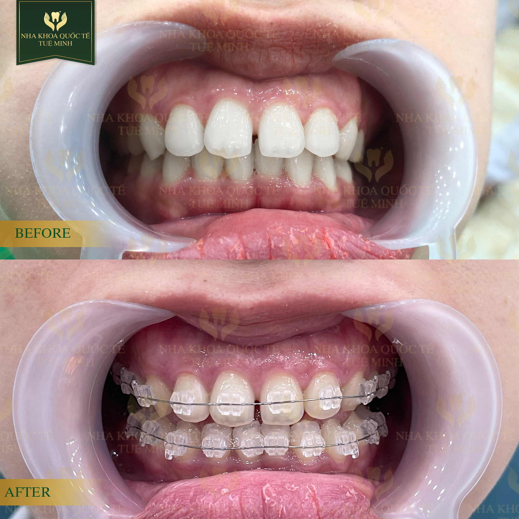 Cách Trị Răng Thưa Tại Nhà: Phương Pháp Hiệu Quả và An Toàn