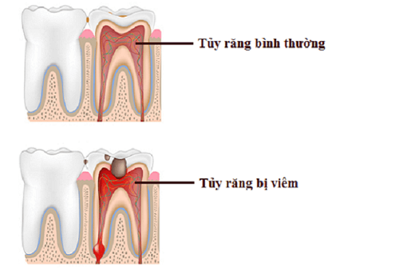 Tủy Răng Là Gì? Dấu Hiệu Của Viêm Tủy – Quy Trình Điều Trị Viêm Tủy Răng