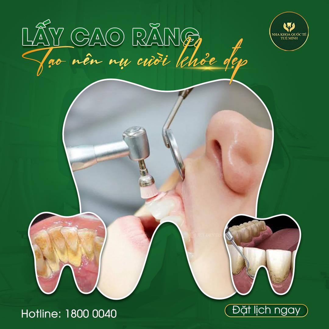 Quy Trình Lấy Cao Răng Hiệu Quả và An Toàn tại Nha Khoa Quốc Tế  TUỆ MINH