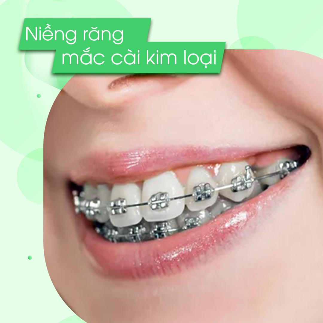Niềng răng – Cải Thiện Vẻ Đẹp và Sức Khỏe Răng Miệng