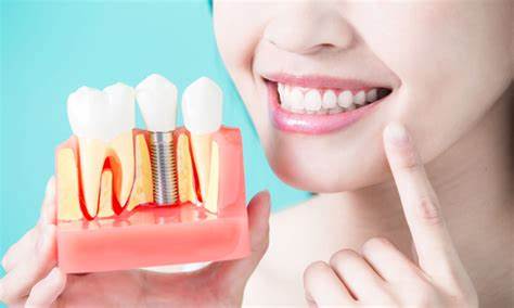 Trồng răng Implant – Khôi Phục Hoàn Hảo Sự Mất Mát Răng và Hàm