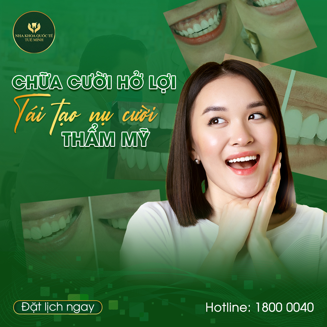Cười Hở Lợi Và Cách Cải Thiện Để Có Một Nụ Cười Tự Tin Rạng Rỡ
