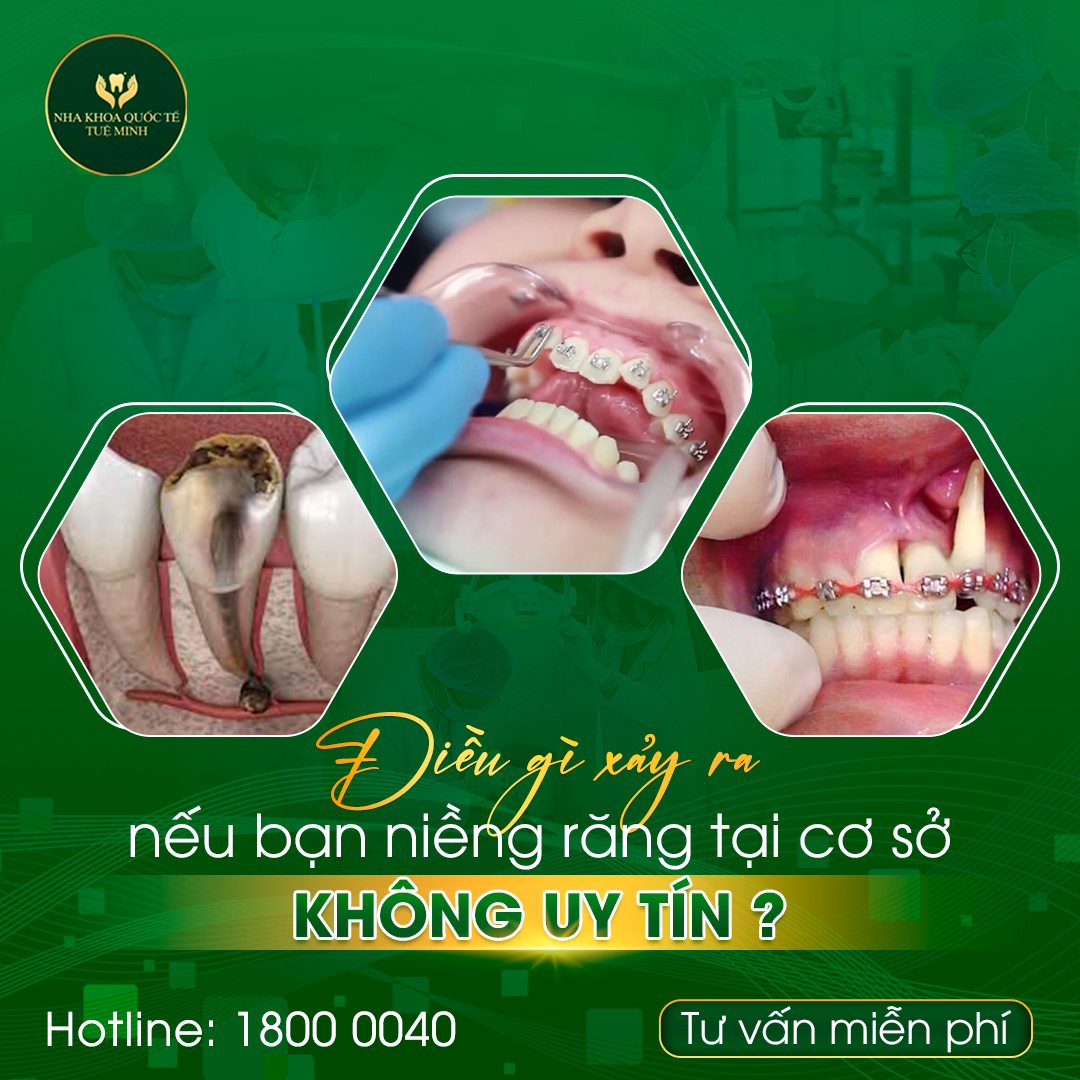 NHỮNG TÁC HẠI CỦA NIỀNG RĂNG SAI CÁCH, SAI QUY TRÌNH MÀ CÓ THỂ BẠN CHƯA BIẾT!