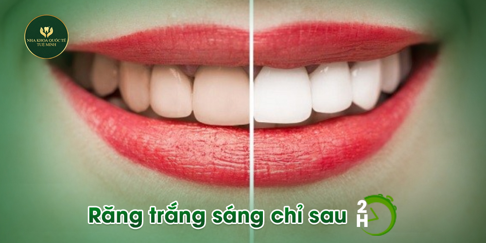 CÓ NÊN TẨY TRẮNG RĂNG HAY KHÔNG ?