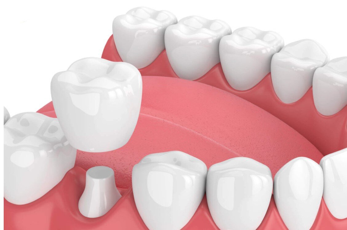 Những điều cần biết khi bọc răng sứ