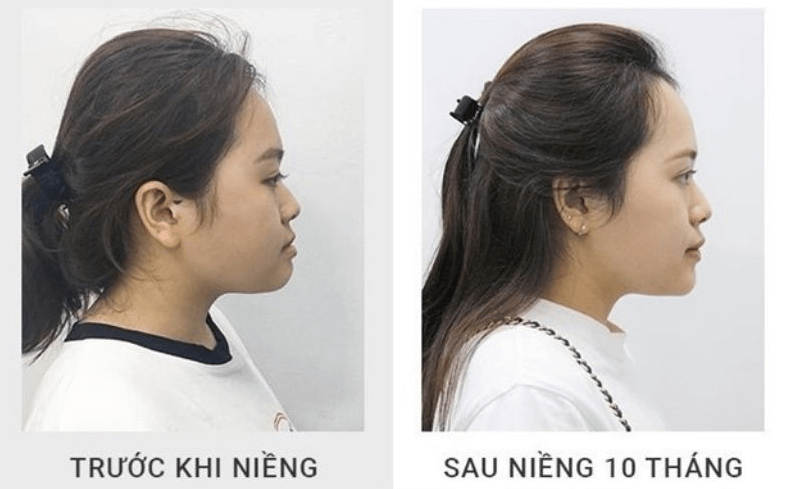 Niềng Răng Có Làm Thay Đổi Khuôn Mặt?