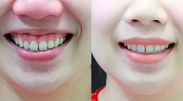 Cắt lợi nên ăn kiêng gì? Cắt lợi bao lâu thì lành?