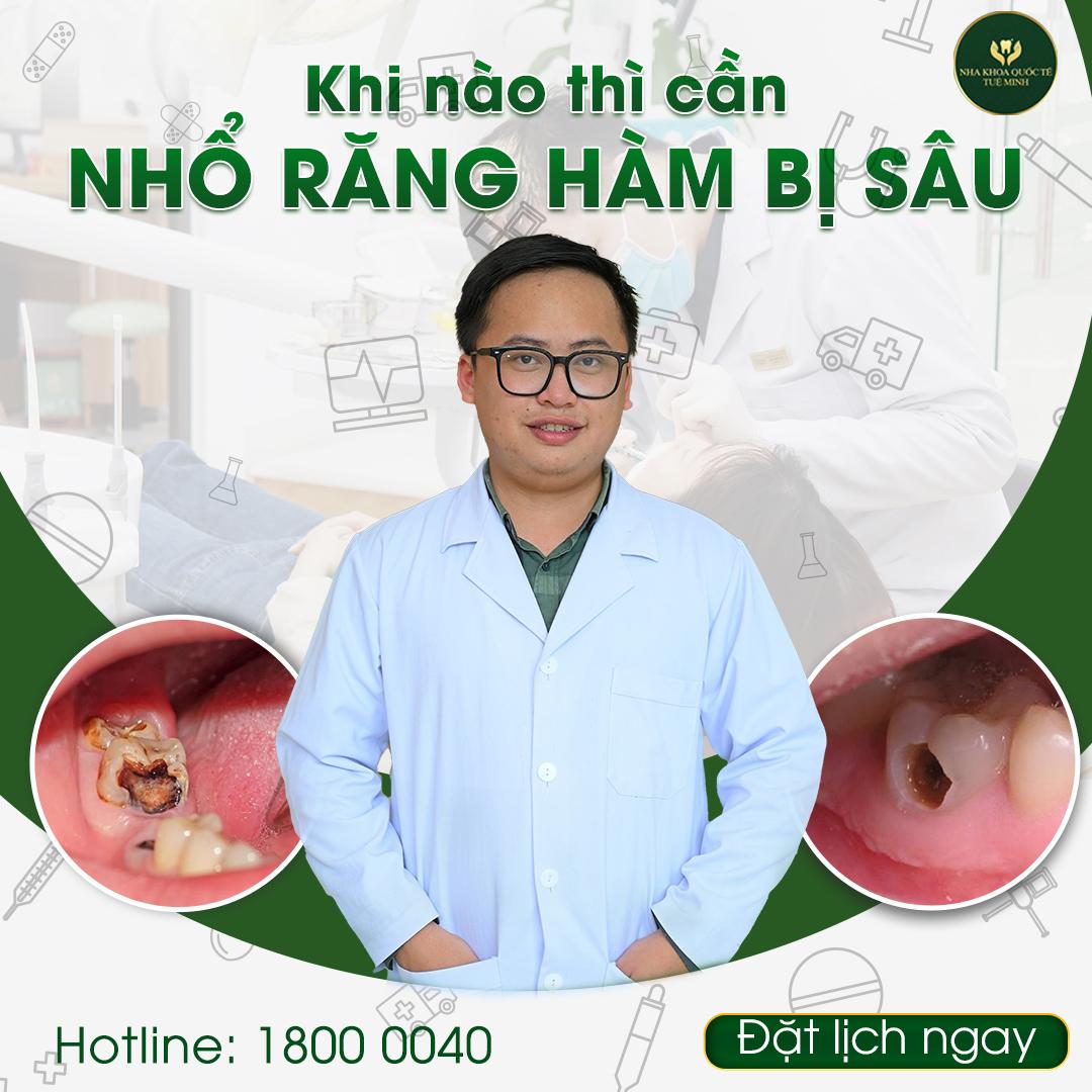 Khi Nào Cần Nhổ Răng Hàm Bị Sâu?
