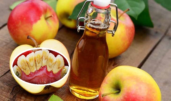 Cách Lấy Cao Răng Lâu Năm Tại Nhà Hiệu Quả