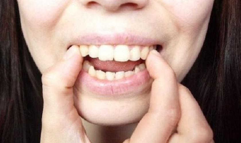 Bài Tập Giúp Giảm Tình Trạng Răng Hô Tại Nhà Đơn Giản