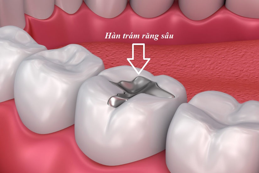 Hàn Răng Vĩnh Viễn: Những Điều Bạn Cần Biết