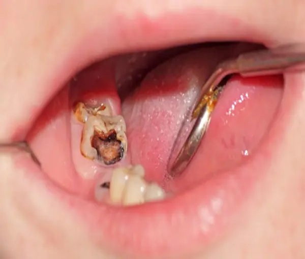 Cách Nhổ Răng Hàm Sâu An Toàn Tại Nhà Cho Bé