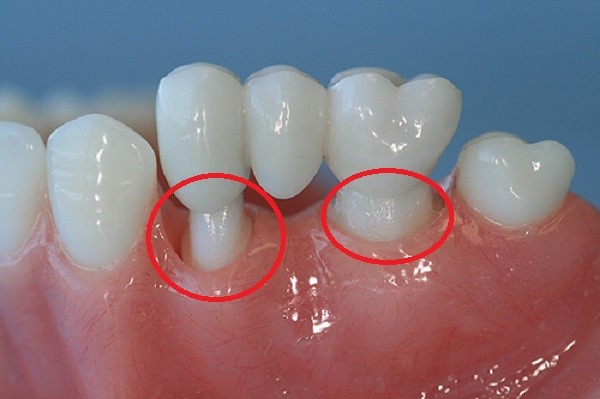 Cùi Răng Giả Là Gì? Ưu Nhược Điểm Của Cùi Răng Giả