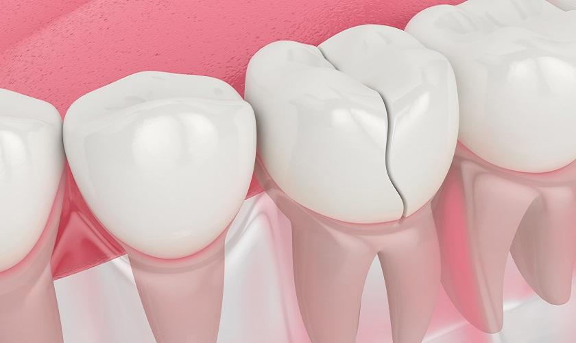 Khắc Phục Tình Trạng Răng Hỏng, Nứt, Hay Mất