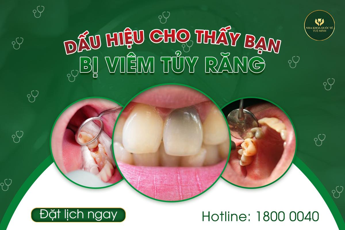 Những Dấu Hiệu cho Thấy Bạn Bị Viêm Tủy Răng?