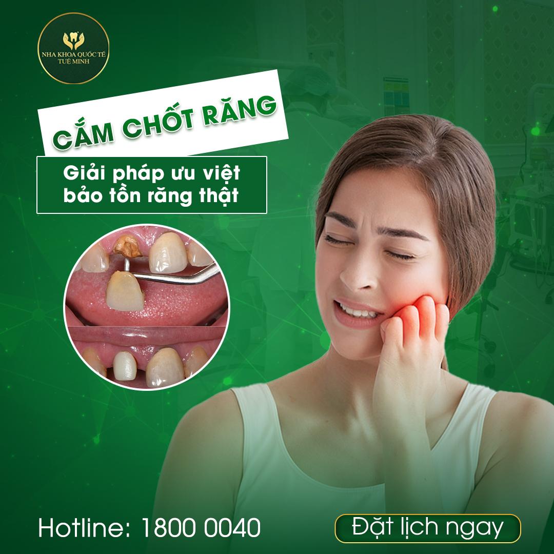 Cắm Chốt – Giải Pháp Đáng Tin Cậy Cho Răng Thiếu Hụt