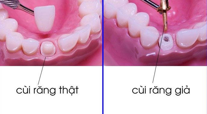 Làm cùi răng giả – Sự Lựa Chọn Hoàn Hảo Cho Nụ Cười Đẹp Tự Nhiên