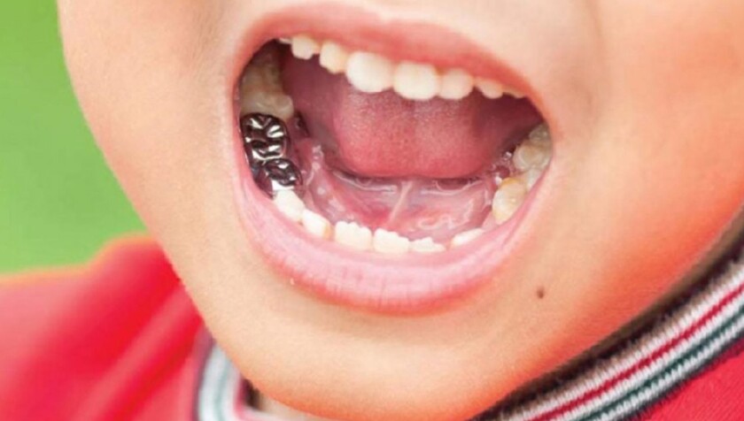 Trẻ Mấy Tuổi Thì Có Thể Hàn Răng Sữa?