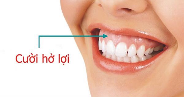 Cười Hở Lợi Là Gì? Nguyên Nhân? Các Mức Độ Cười Hở Lợi