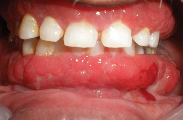 Những Biến Chứng Sau Khi Cắt Lợi Trùm