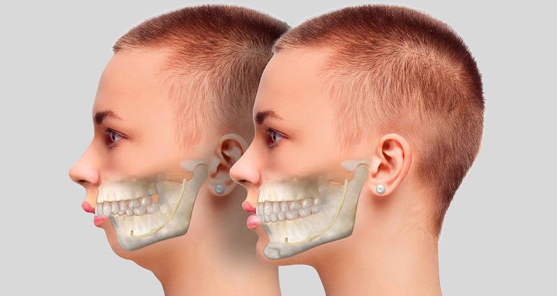 [Giải đáp thắc mắc]: Chữa răng hô nhưng không cần niềng răng được không?