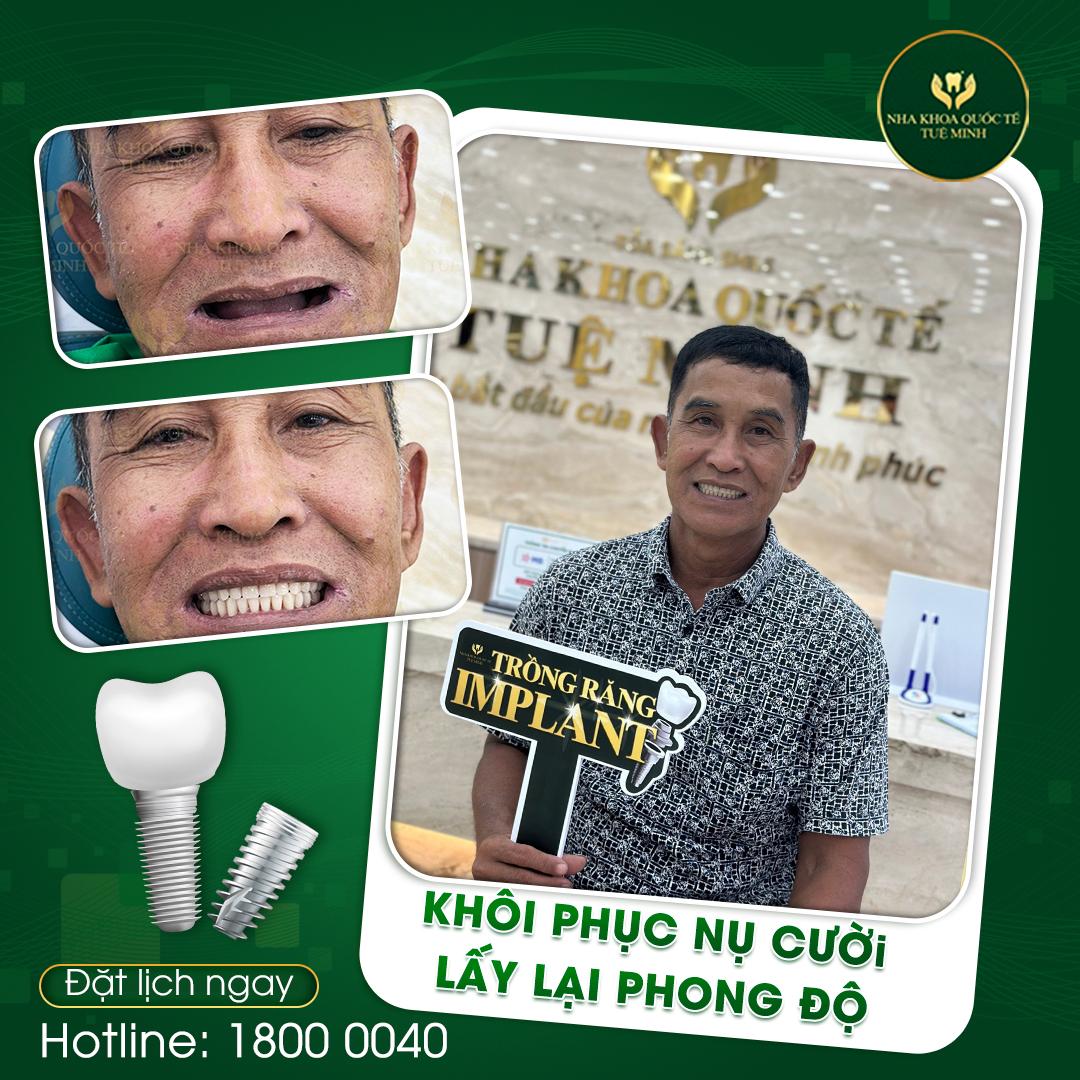 Mất Răng Tình Trạng Phổ Biến Ở Người Lớn Tuổi 