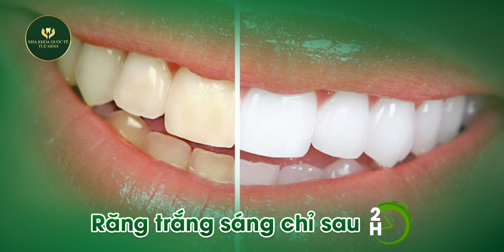 Răng Sứ Bị Ố Vàng Nguyên Nhân Và Cách Phòng Tránh!