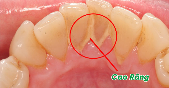 Cao Răng: Nguyên Nhân, Hình Thành và Giải Pháp Tại Nha Khoa Quốc Tế Tuệ Minh