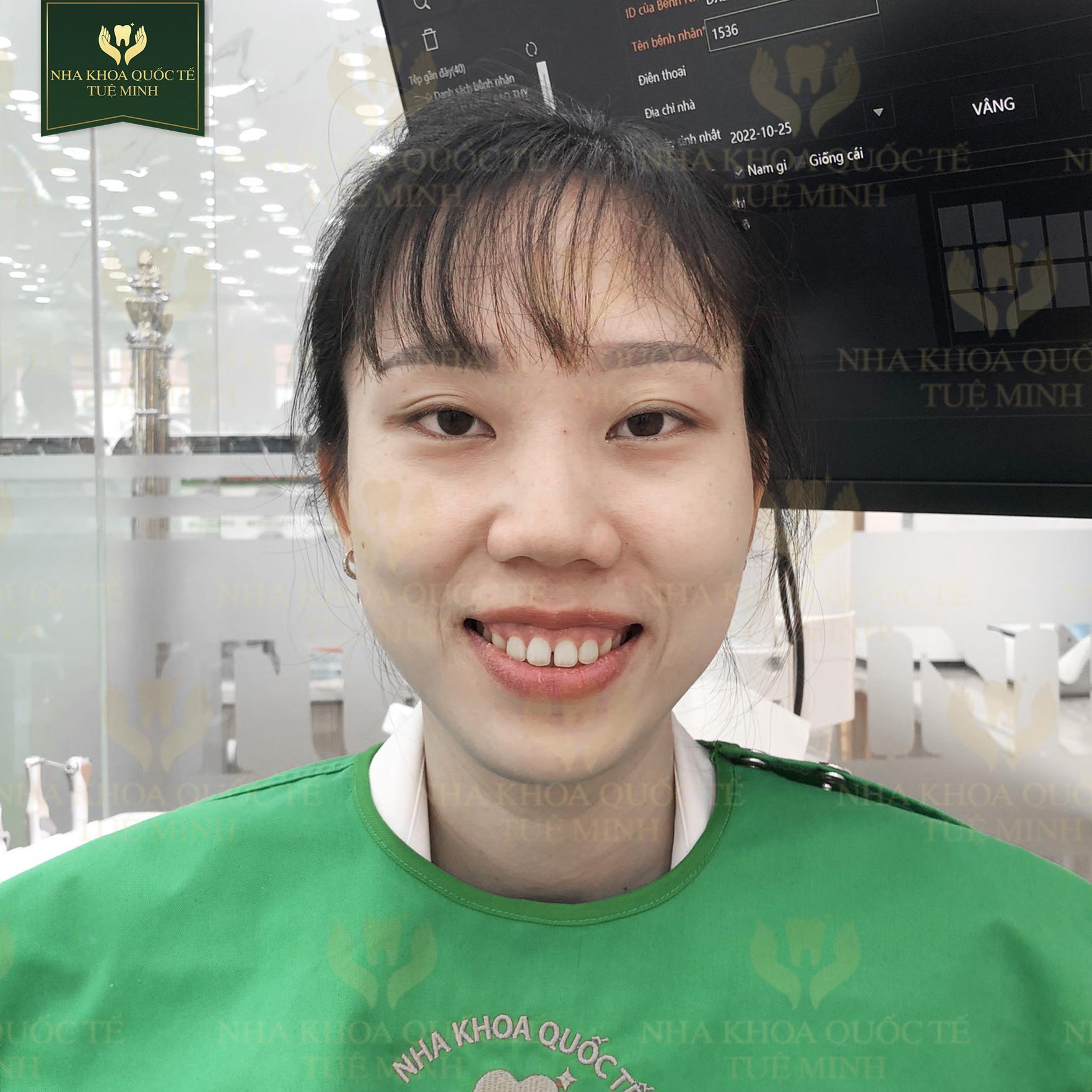 Răng Thưa Nên Niềng Hay Bọc Sứ? Lựa Chọn Phù Hợp Cho Bạn!