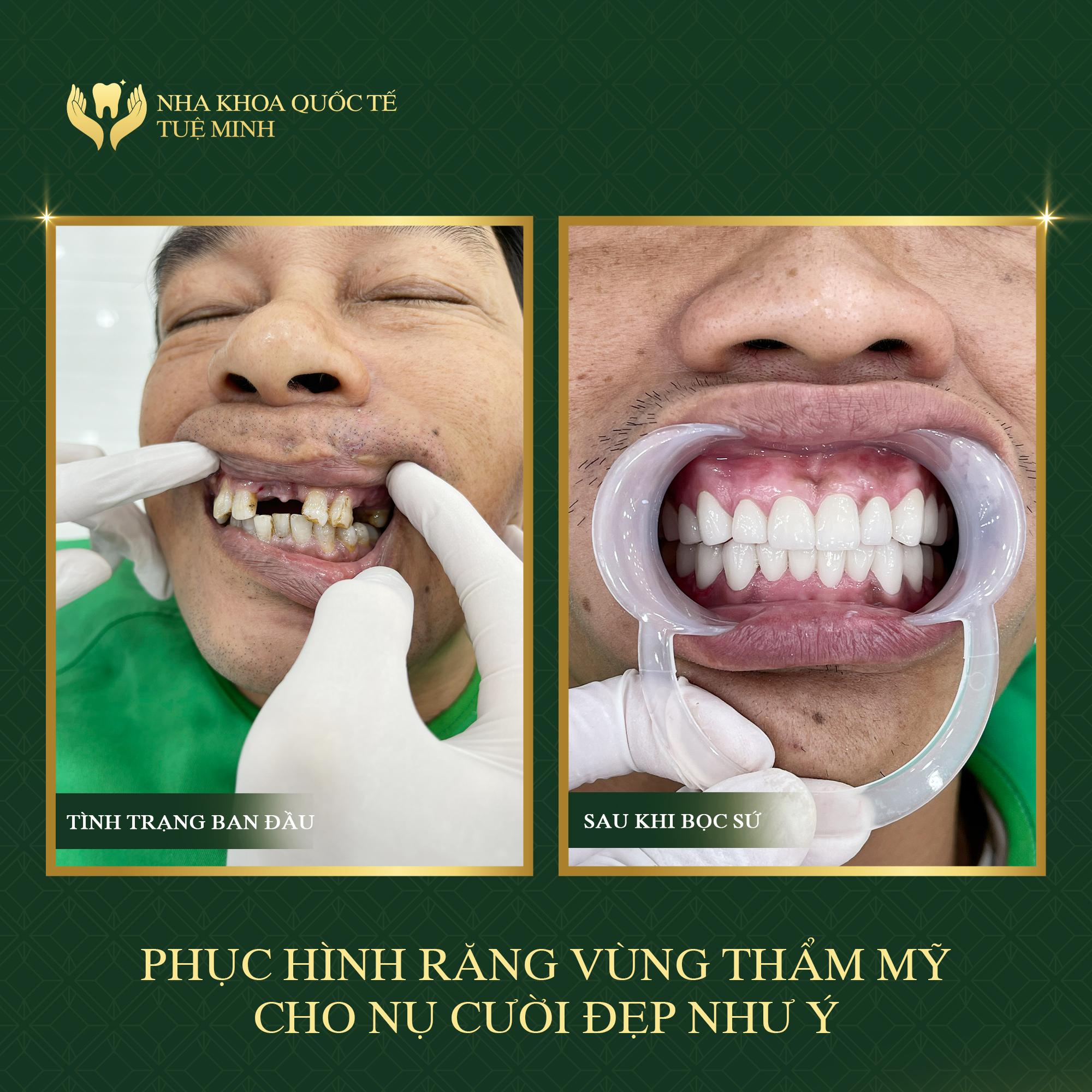 Tìm Lại Chiếc Răng Bị Mất Chỉ Sau 48h Tại Nha Khoa Quốc Tế Tuệ Minh!