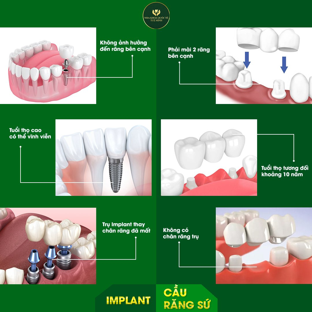 Khi Mất Răng: Nên Cắm Implant Hay Làm Cầu Răng Sứ?