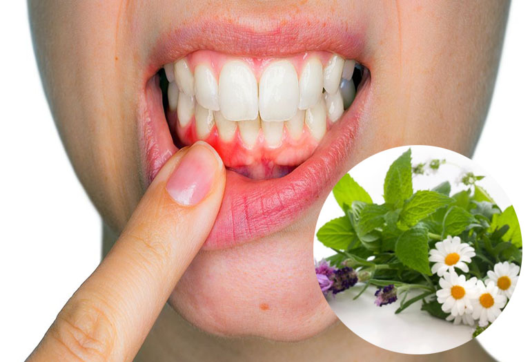 Các cách trị viêm chân răng tại nhà!