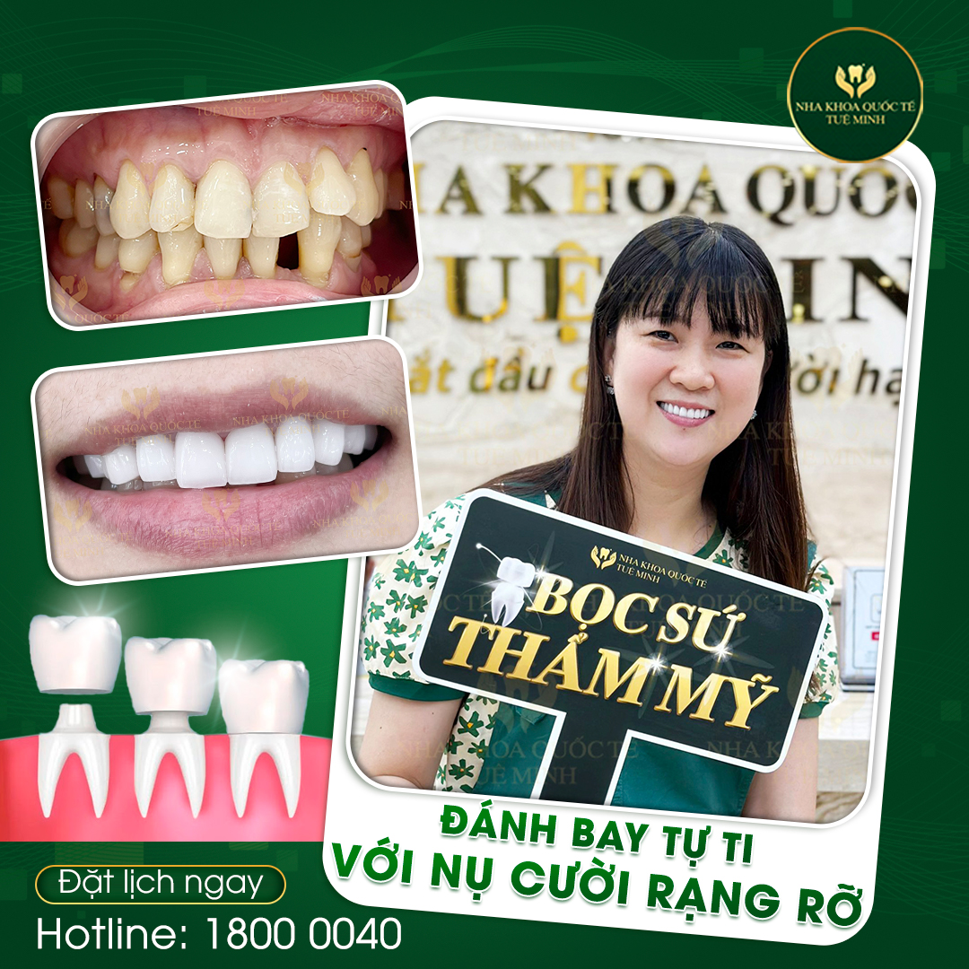 RĂNG XẤU NẶNG ĐẾN ĐÂU CŨNG “ĐẸP NGAY” VỚI BỌC RĂNG SỨ TẠI NHA KHOA QUỐC TẾ TUỆ MINH!