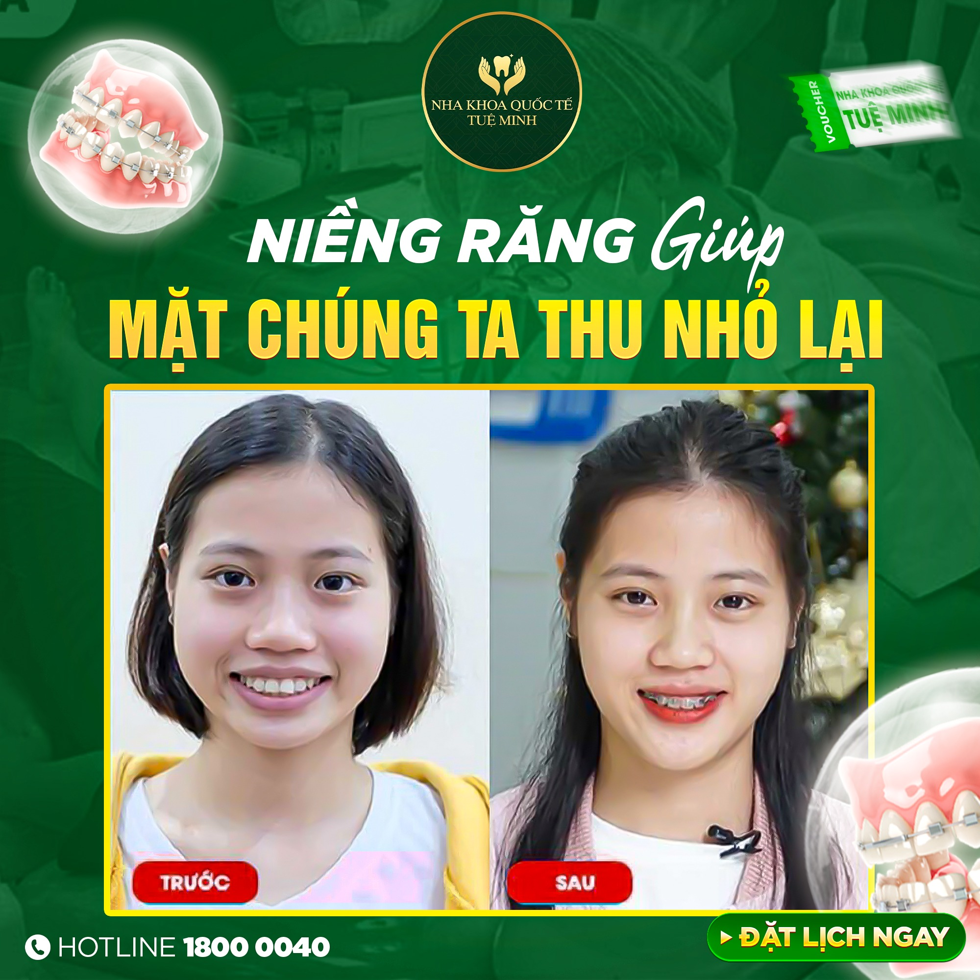 NIỀNG RĂNG GIÚP MẶT THU NHỎ LẠI?