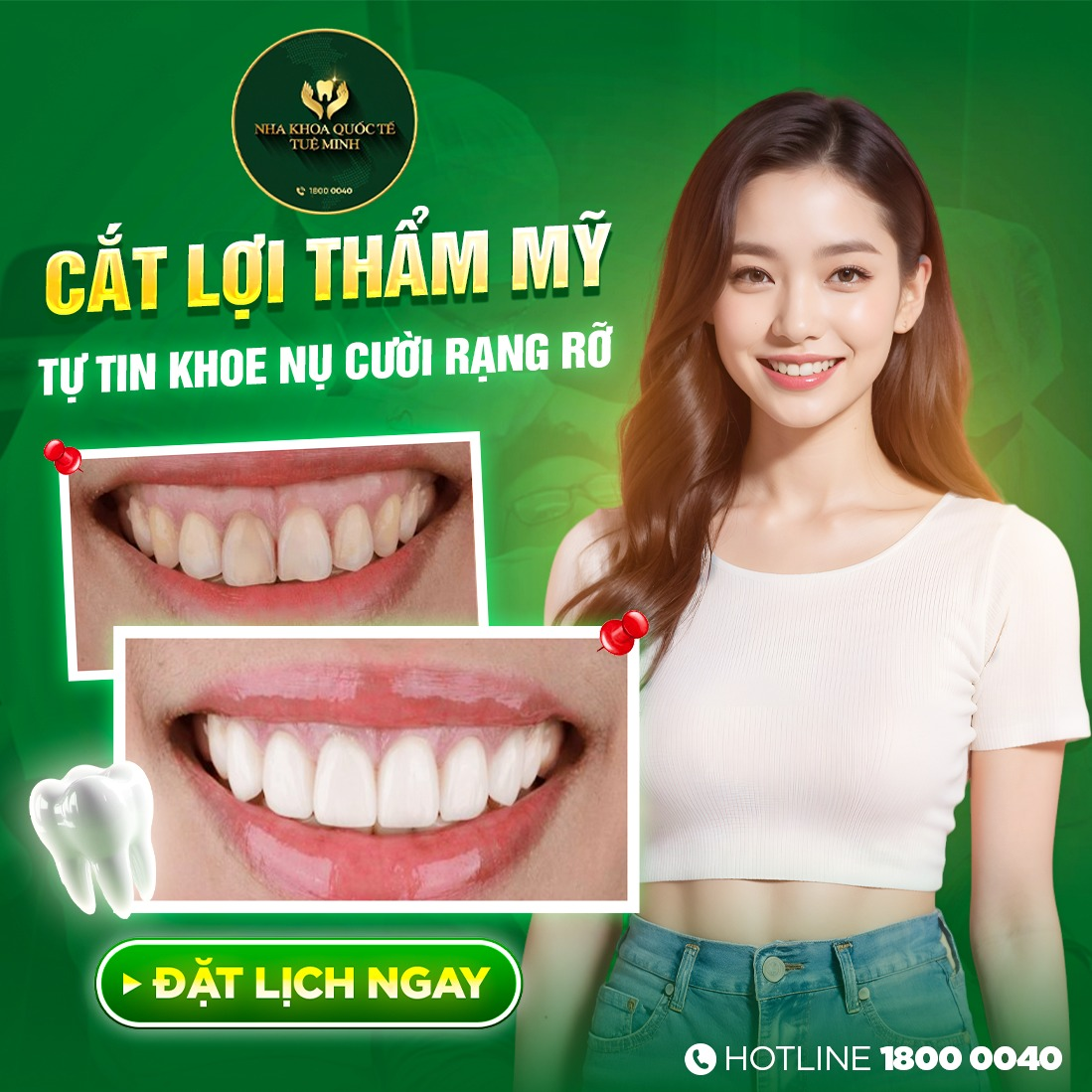 Cắt Lợi Thẩm Mỹ – Tự Tin Khoe Nụ Cười Rạng Rỡ!