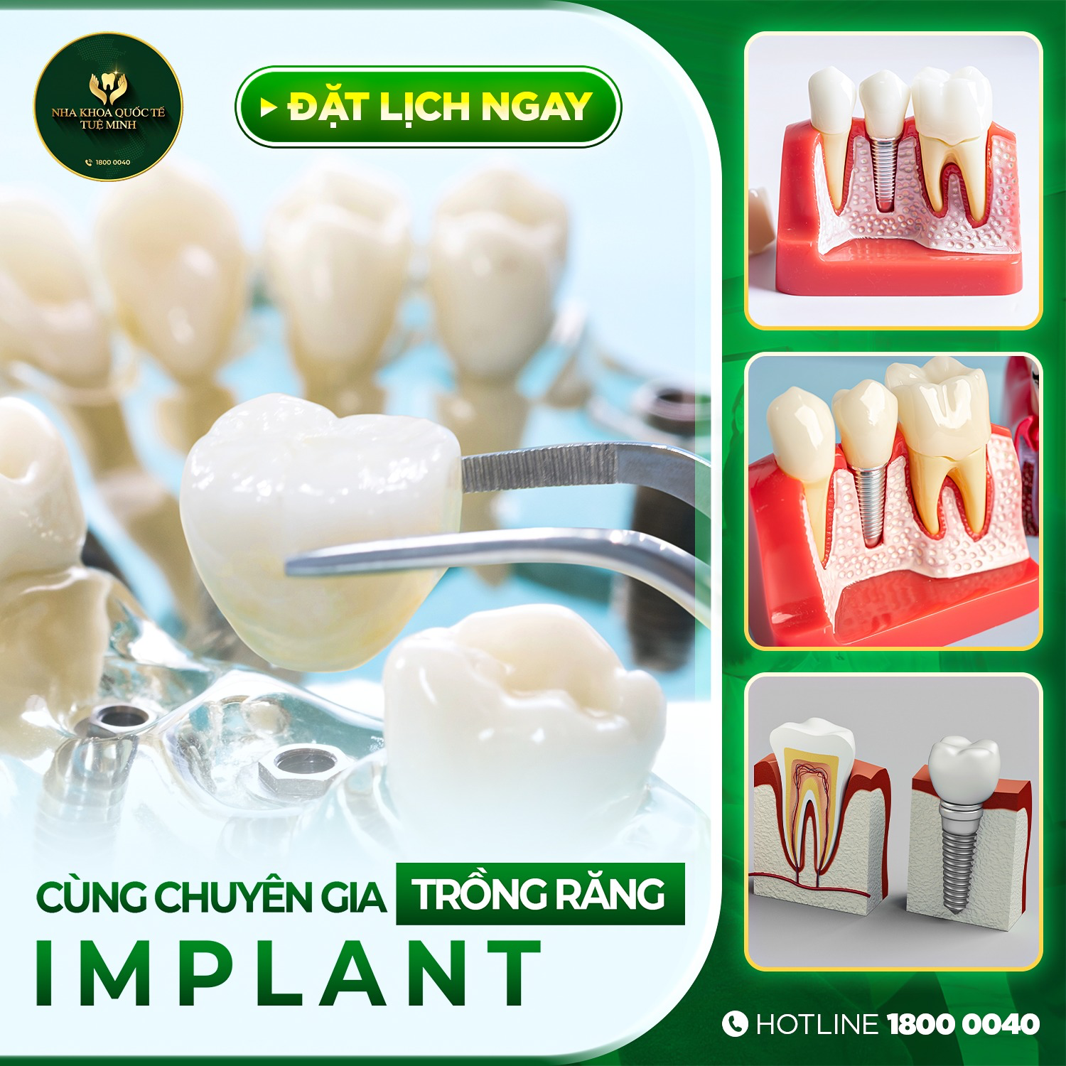 CÙNG CHUYÊN GIA TRỒNG RĂNG IMPLANT – KHÔI PHỤC NỤ CƯỜI TỰ TIN