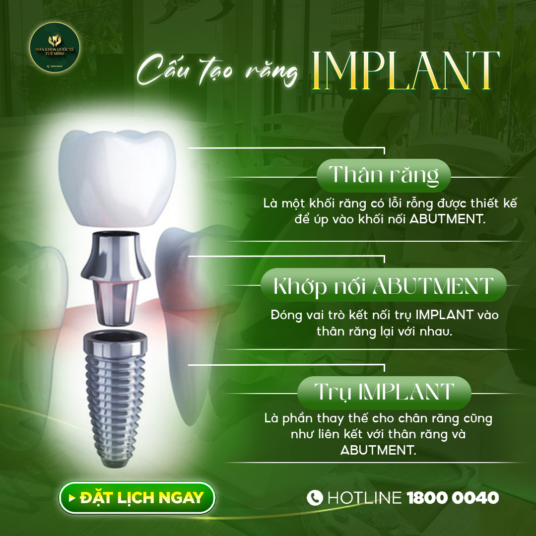 Khám Phá Cấu Tạo Răng Implant – Giải Pháp Hoàn Hảo Cho Răng Mất!
