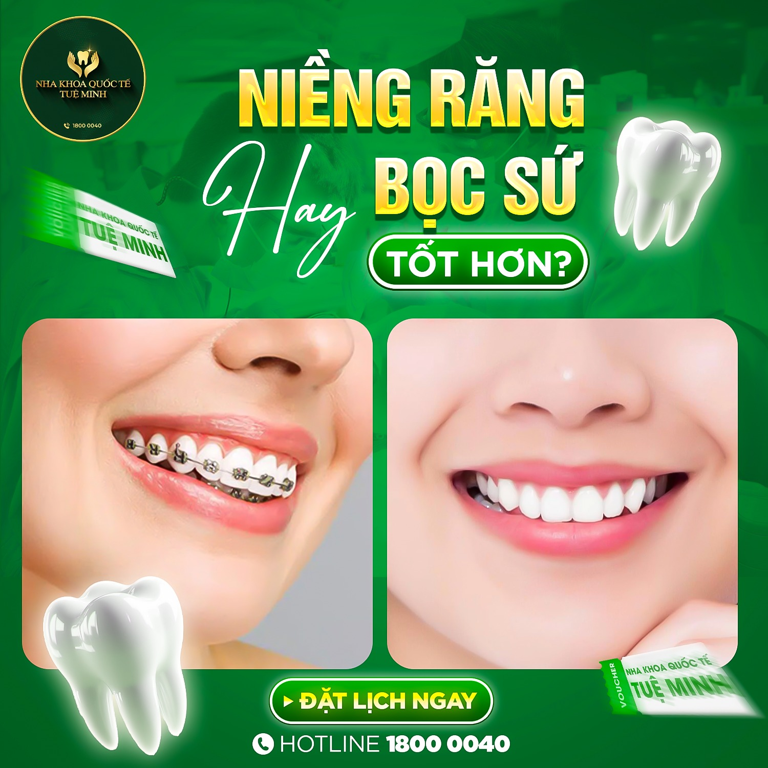 NIỀNG RĂNG HAY BỌC SỨ: ĐÂU LÀ LỰA CHỌN TỐT NHẤT CHO NỤ CƯỜI CỦA BẠN?
