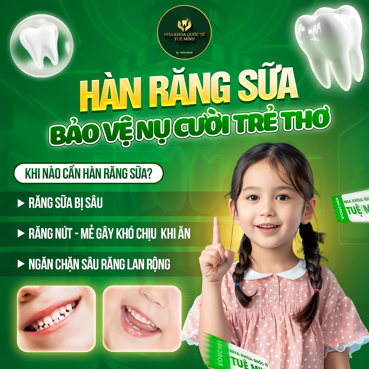 HÀN RĂNG SỮA – BẢO VỆ NỤ CƯỜI TRẺ THƠ!