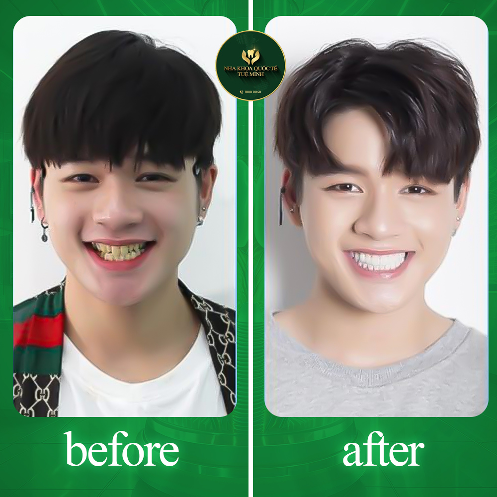 TRƯỚC & SAU KHI LÀM RĂNG SỨ
