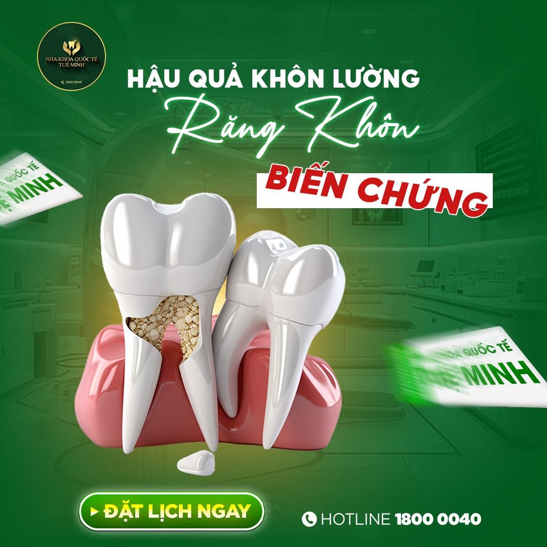 Hậu Quả Khôn Lường Răng Khôn Biến Chứng – Đừng Chủ Quan!