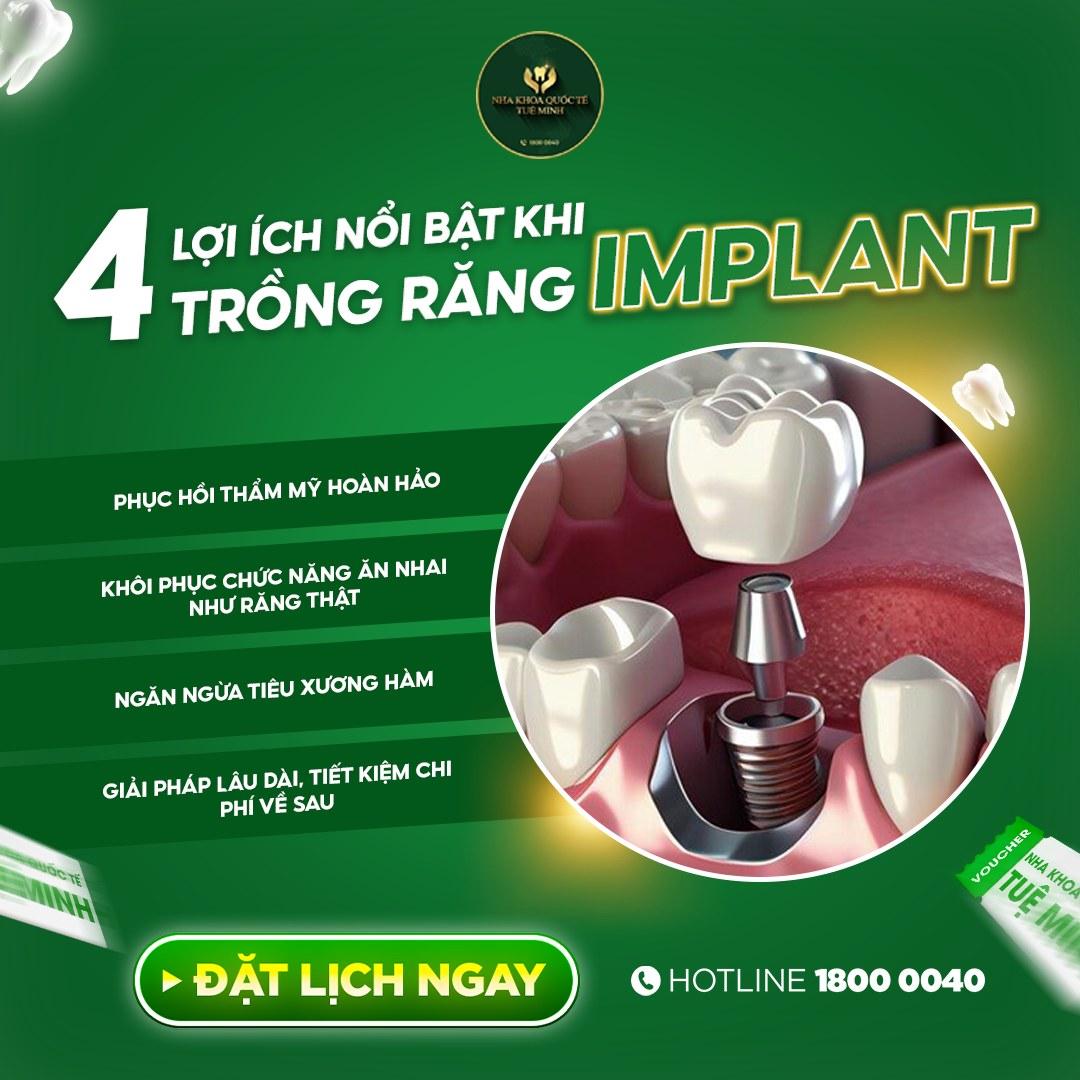 4 Lợi Ích Nổi Bật Khi Trồng Răng Implant