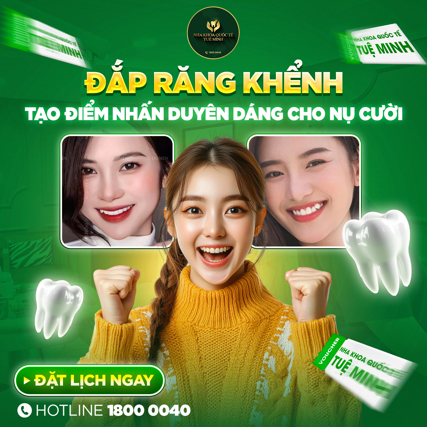 Đắp Răng Khểnh: Giải Pháp Hoàn Hảo