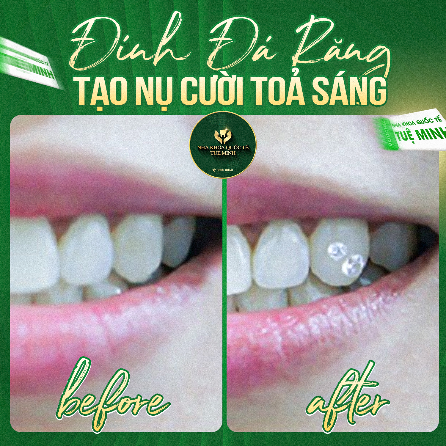 ĐÍNH ĐÁ RĂNG – TẠO NỤ CƯỜI TOẢ SÁNG