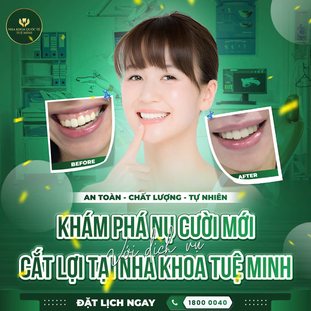Khám Phá Nụ Cười Mới Với Dịch Vụ Cắt Lợi